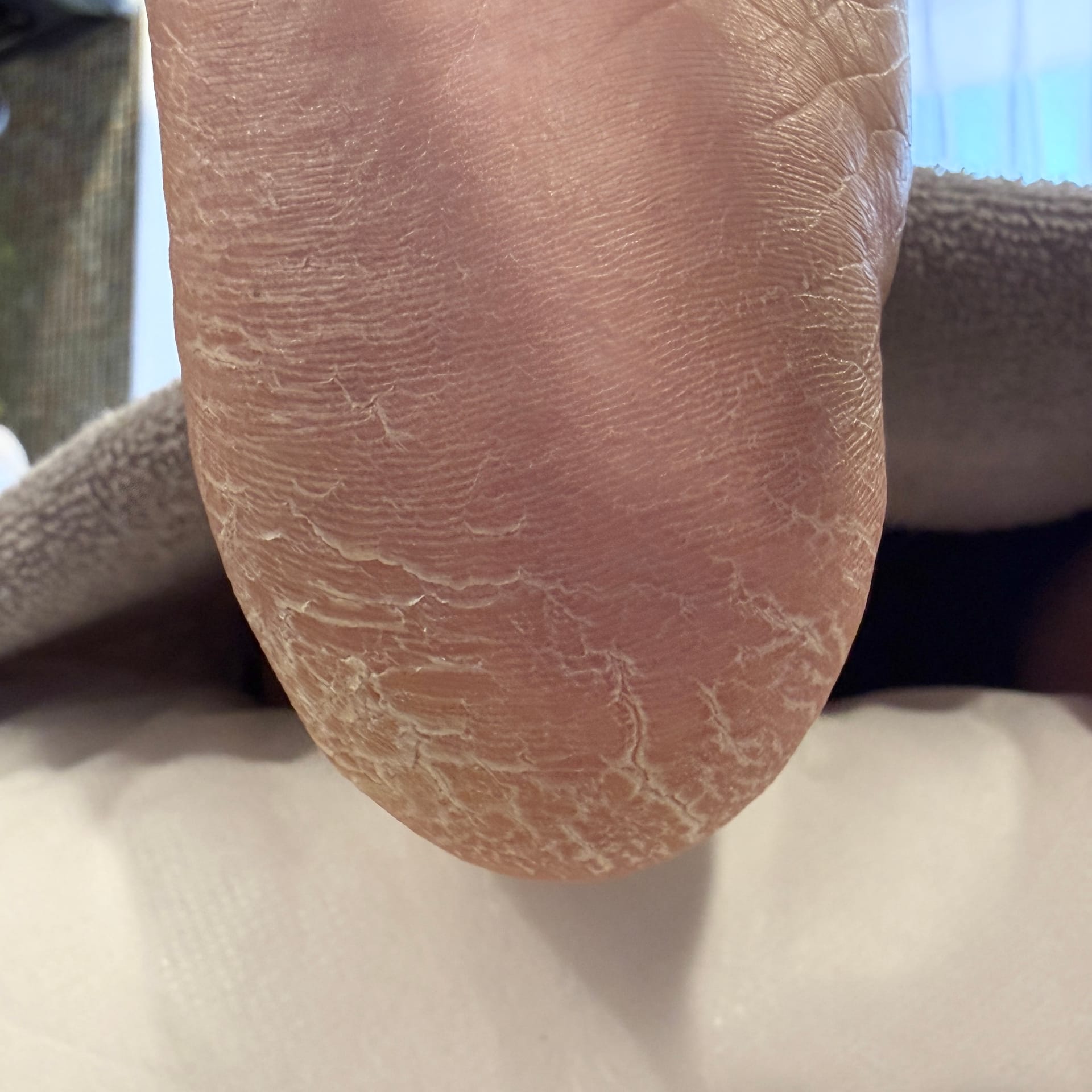 足裏角質ケア Before